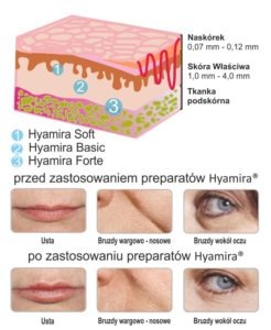 acid hialuronic hyamira pareri)